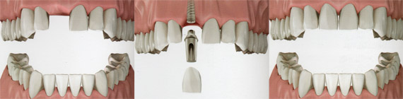 Secuencia de tratamiento en implantología diente unitario