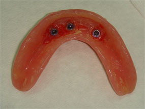 Imagen diente en implantología prótesis removible protésis removibles
