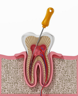 Imagen diente en endodoncia