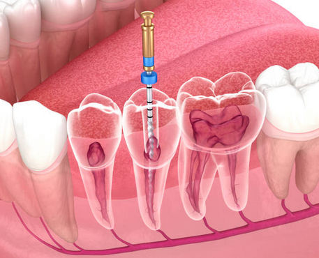 Detalle de una endodoncia