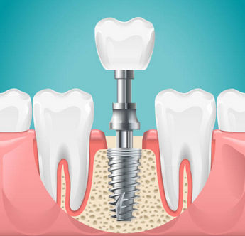 Imagen diente en implantología diente unitaria