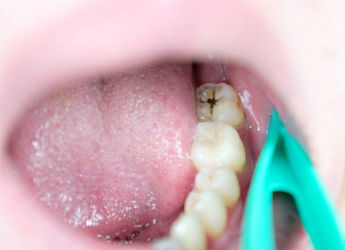 Imagen diente en ortodoncia