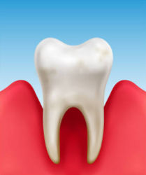 Diente afectada por periodontitis