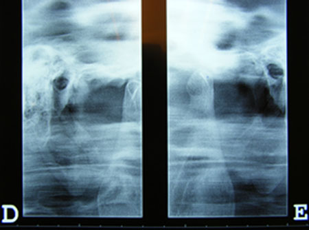 radiografía temporomandibular