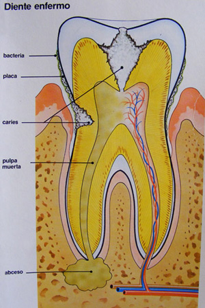 Imagen diente enfermo endodoncia