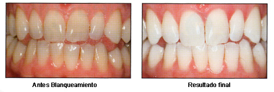Imagen tratamiento blanqueador estética dental