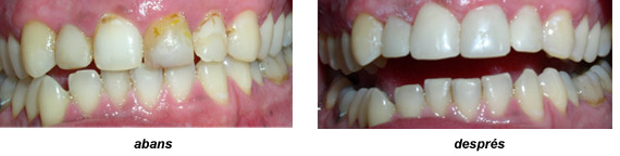 Imatge carilles composite tractament exemple 3