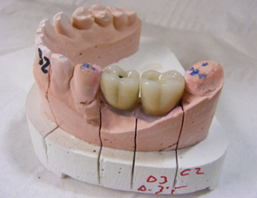 Imatge dent en implantologia