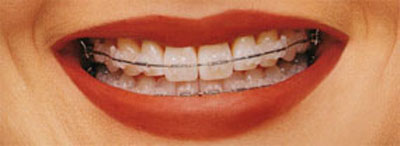 Imagen ortodoncia fija con brackets