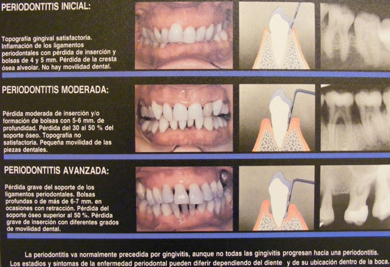 Imatge evolució enfermetat periodoncitis