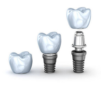 Imatge dent en implantologia