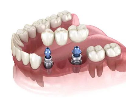 Implantologia de vàries dents consecutives
