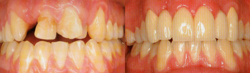 Imagen de puentes en prótesis dentales